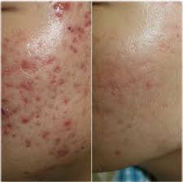 Батганы сорвийг гэрийн нөхцөлд арилгах арга